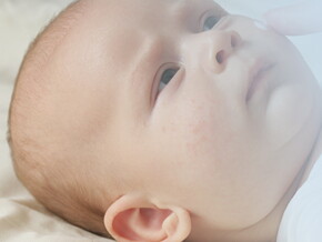 Alergias en niños y bebés Alergias en niños y bebés
